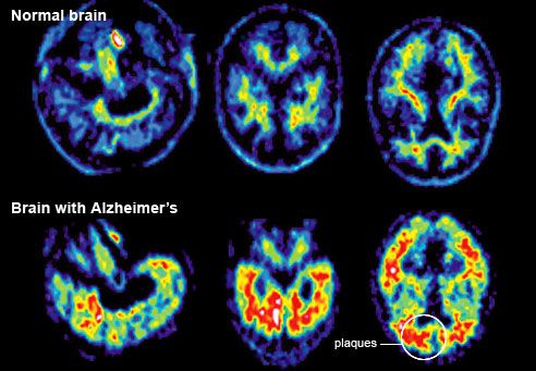 Az Alzheimer-kór tünetei CT felvételen