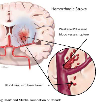 Stroke Hemorrhage - Szélütés