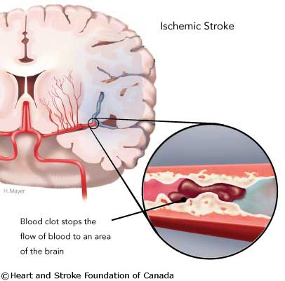 Stroke Iscemia - Isémiás Stroke